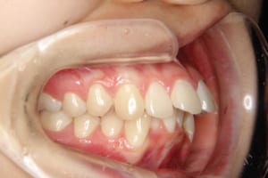 上の前歯は前突し下の前歯は叢生になっています